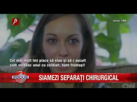 Video: Separarea Cu Succes A Gemenilor Siamezi Din China - Vedere Alternativă