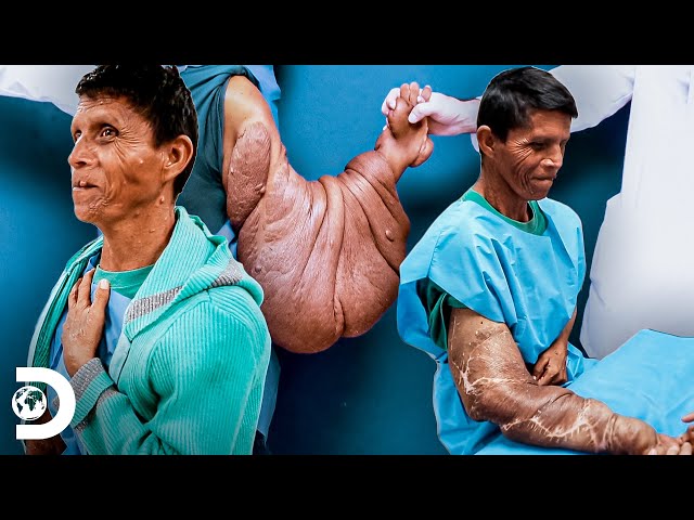Mujer se niega a tratar tumoración en su brazo | Mi cuerpo, mi desafío | Discovery Latinoamérica - YouTube