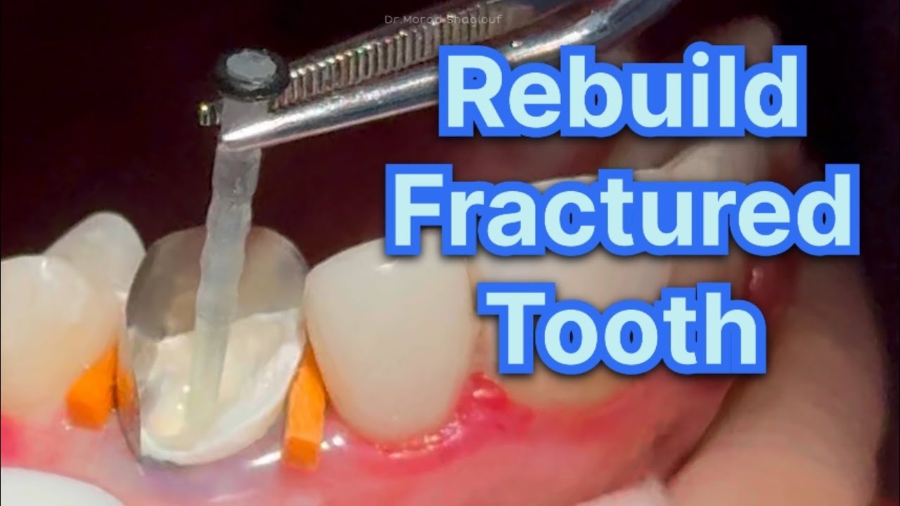 Rebuild Fractured Tooth 🦷 With Fiber Post - YouTube