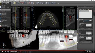 Introduction to Guided Surgery (Everything Blue Sky Plan - Part 1) screenshot 2