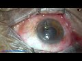 Removal of intracorneal Foreign Body (Drumstick) : Pradip Mohanta, 29th March, 2021