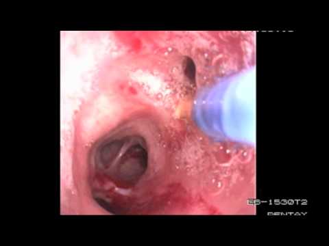 Lee Bass, MD, explains capsuleLee Bass, MD, explains capsuleendoscopyLee Bass, MD, explains capsuleL. Lee Bass, MD, explains capsuleLee Bass, MD, explains capsuleendoscopyLee Bass, MD, explains capsuleL.
