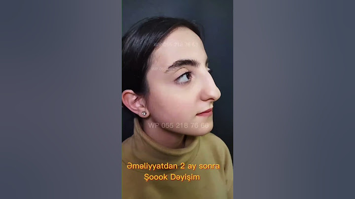 “Bu qızın burun əməliyyatı hamını şoka saldı! 😱👃” #rinoplastika #burunəməliyyatı #qadınestetikası