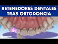 RETENEDORES DENTALES - Cómo evitar que se muevan los dientes tras la ortodoncia ©
