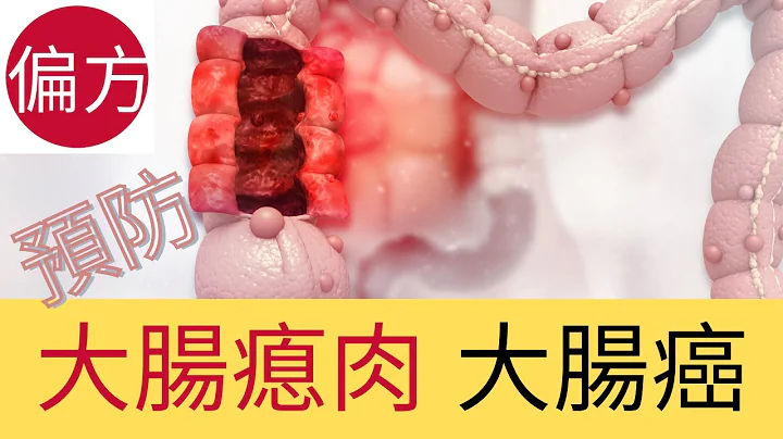 对抗大肠瘜肉，大肠癌 - 天天要闻