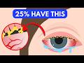 Blepharitis Explained: Why Your Eyelids Are Crusty and Irritated
