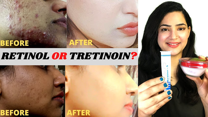 What is the difference between tretinoin and retinol