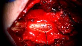 Prof Dr Yusuf Sukru Caglar - C5-C6 Schwannoma Surgery