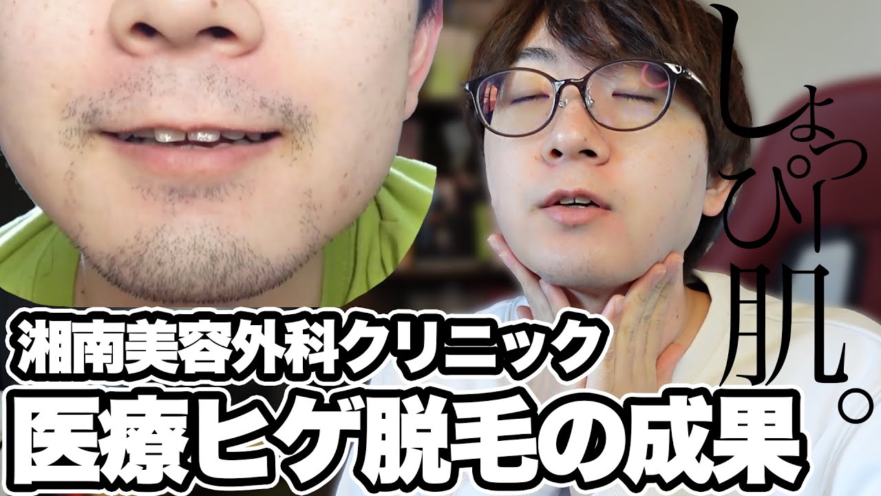 【検証】SnowManしょっぴーが広告塔 SBCメンズ髭脱毛6回コースの効果はどれほどか？