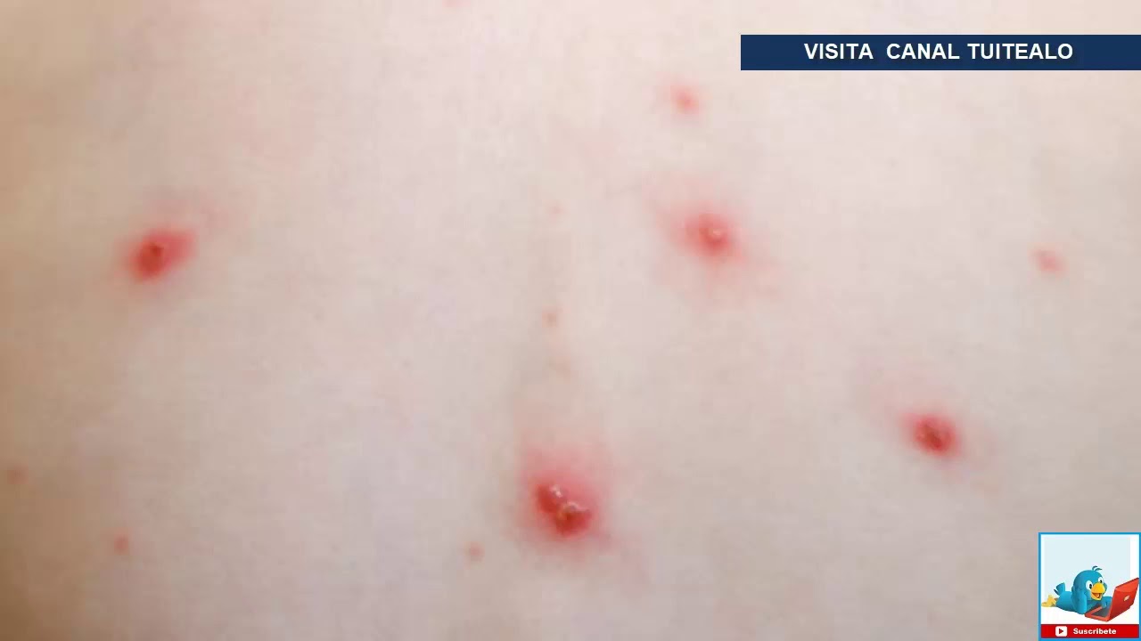 La culebrilla de enfermedad