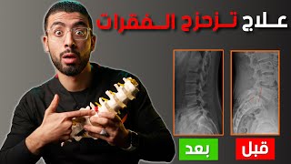 تزحزح الفقرات القطنية | الأسباب - الأعراض - تمارين العلاج الطبيعى | Lumbar spondylolithesis