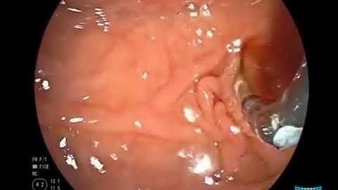 Primary Sclerosing Cholangitis and Brush Cytology Sampling