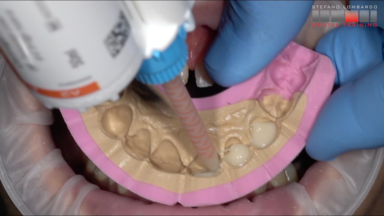 Wax Up and Mock Up with PreVISION Temp by Kulzer YouTube
