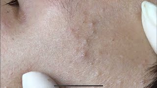 ACNE TREATMENT WITH VU QUYNH MI | Blackheads Removal & Cystic Removal For Boy 2023 Resimi