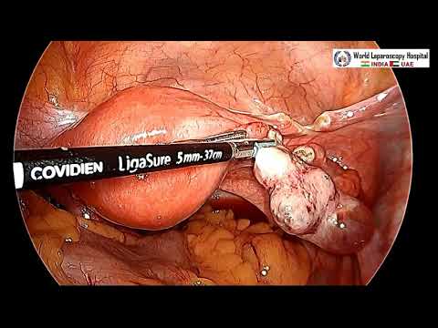 laparoscopic-hysterectomy-with-ureteral-stent-placement