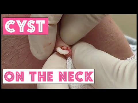 Small Cyst On Neck That Is Recurrent: Punch Removal