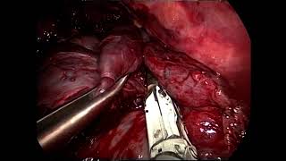 Büllöz Akciğer - Stapler Vats Ameliyatı