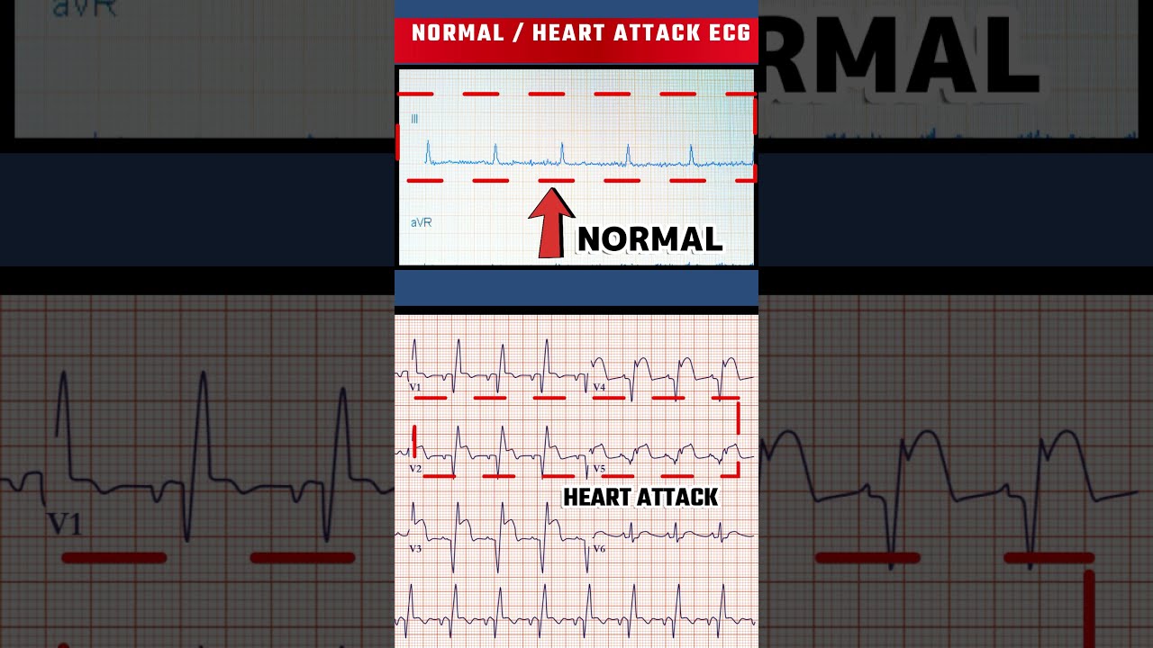  ECG HEART ATTACK VS NORMAL Shorts