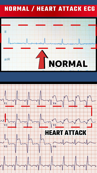 हार्ट अटैक का ECG - HEART ATTACK ECG VS NORMAL ECG#shorts