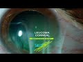 Leucoma Corneal