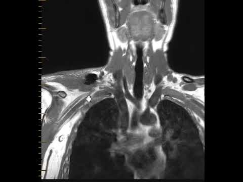 تصویری: آیا mri آسیب شبکه بازویی را نشان می دهد؟