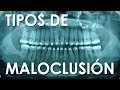 TIPOS DE MALOCLUSIÓN | RECONOCE TU TIPO DE MORDIDA