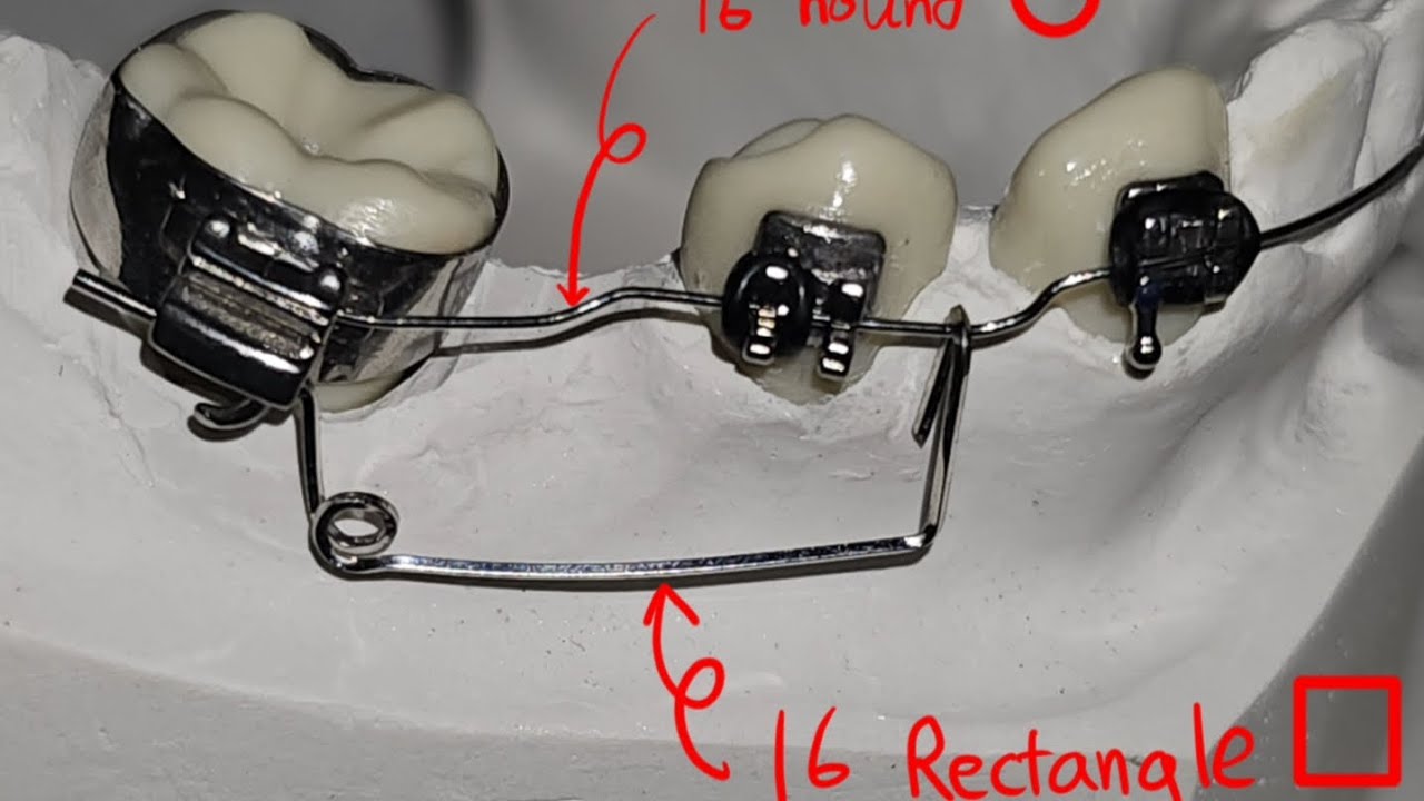 Mini Spring Uprighting Spring uprighting spring to upright mandibular molar - YouTube