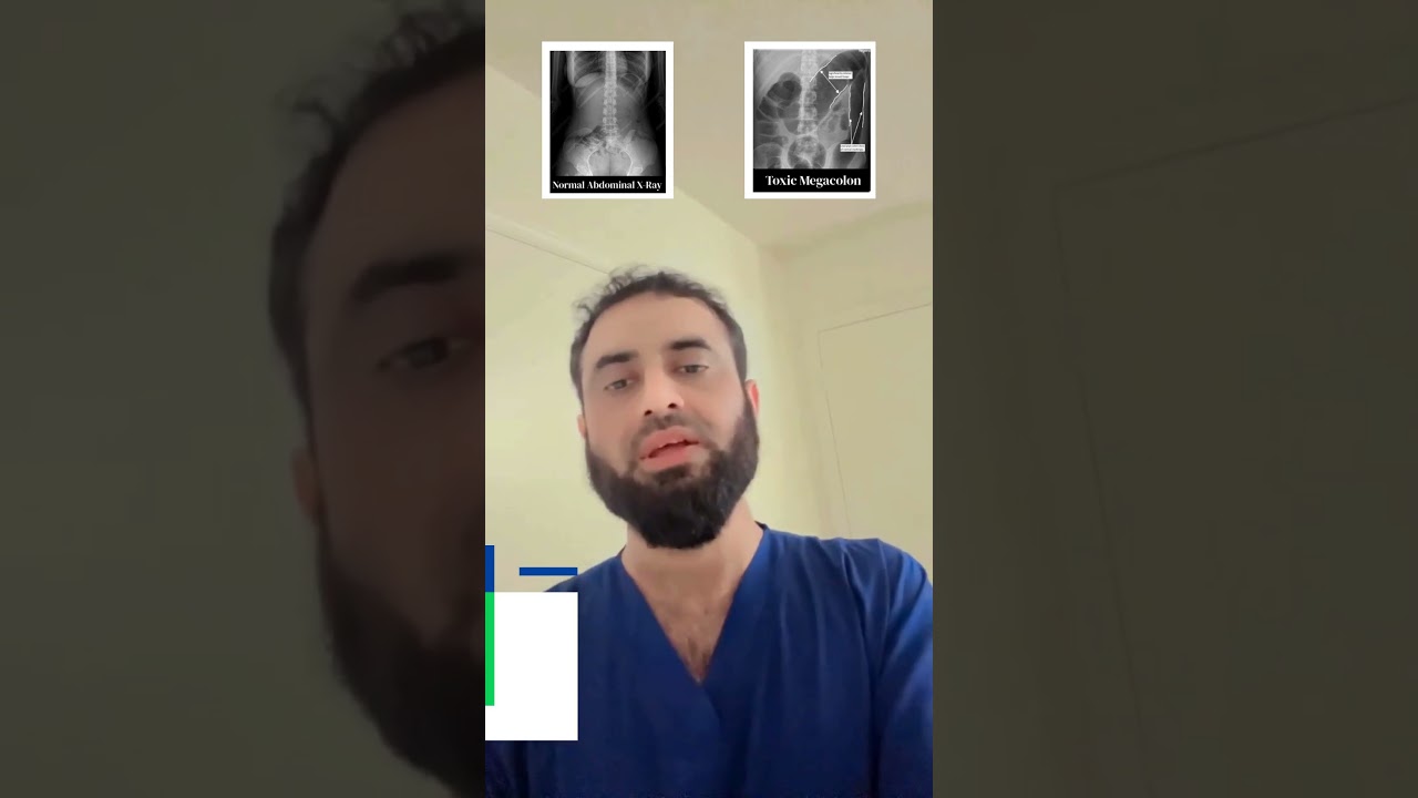 Toxic Megacolon | Exam Key Points | Dr Hafiz Atif | FAME Platform #FCPS #NRE #USMLE #Examtips