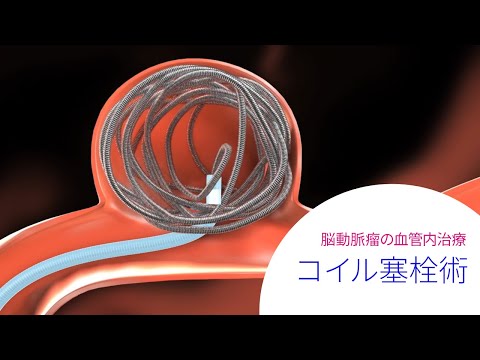 血管内治療コイリング術 (Endovascular Coiling for Brain Aneurysm)