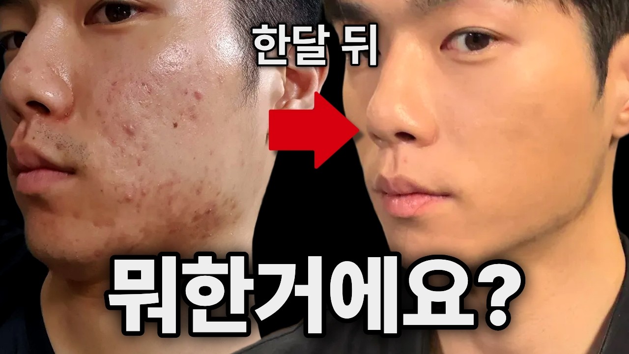 따라하면 한달만에 피부 좋아지는 여드름 삭제 세안법, 루틴