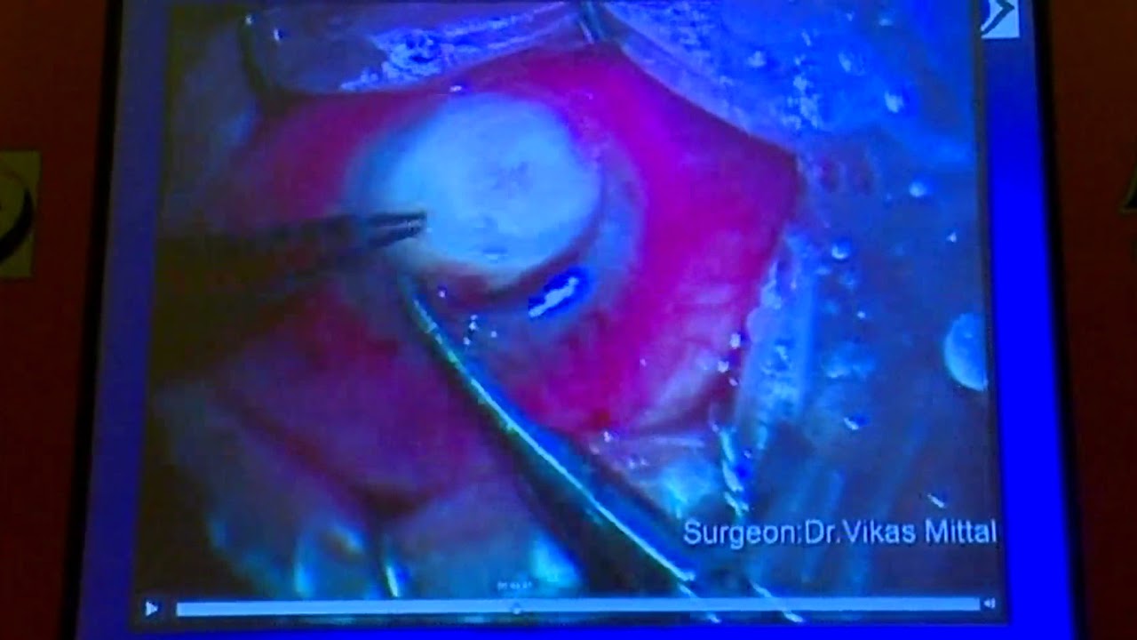 AIOC2018 - IC251- Topic - Voriconazole v/s natamycin in the management of fungal keratitis ..