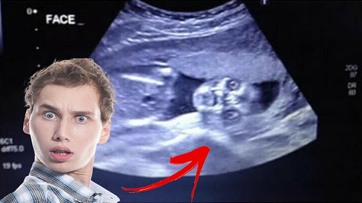 Dad Almost Faints When He Sees Ultrasound. Nurse Was Shook Saying It's 1 In 15 Million