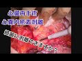 【心臓再手術】 心嚢内癒着剥離 僧帽弁形成術後 安全に剥離できますか? 【俺に切らせろ!】