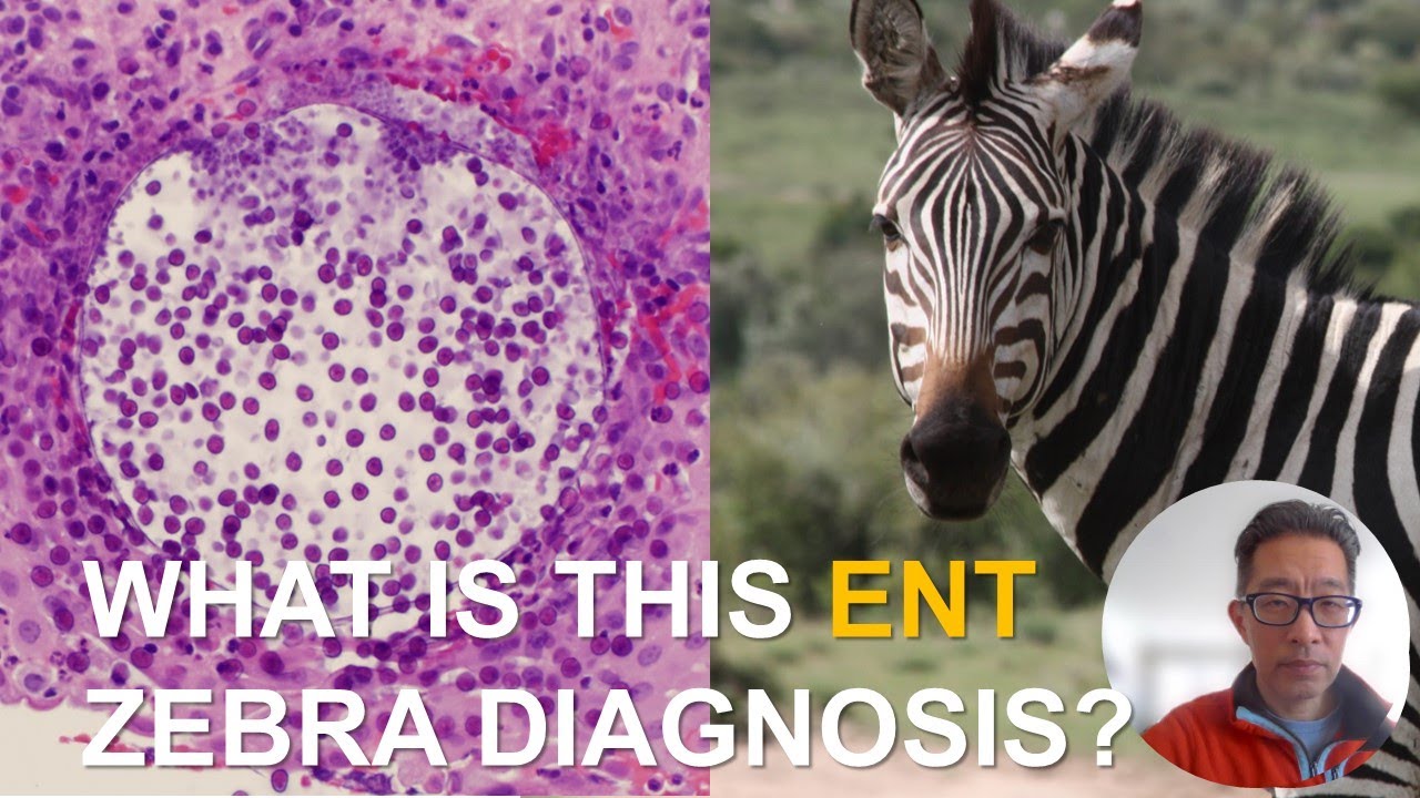 What is this ENT zebra diagnosis? - YouTube