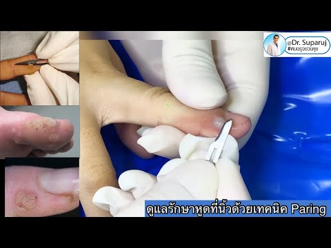 ดูแลรักษาหูด Wart ที่นิ้วด้วยการ Paring