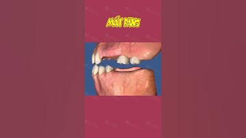 [3D] MẤT RĂNG || Nha Khoa Quốc Tế Athena