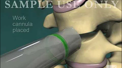 Anterior Cervical Discectomy and Fusion