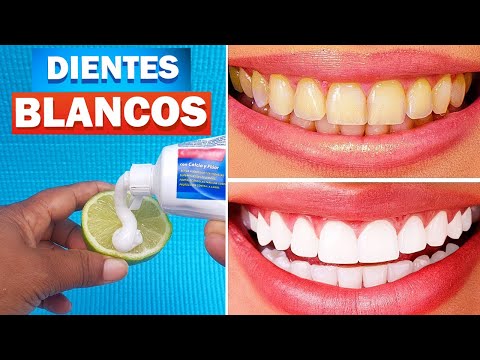 Video: 3 formas de blanquear los dientes rápidamente