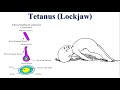 Tetanus: The Deadly Consequences of Neglected Wound Infections | Lockjaw | Tetanospasmin