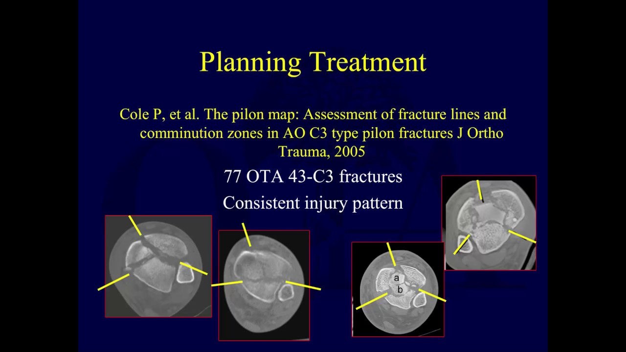 tibial plafond fractures assessment ota lecture series iv l11a tibial plafond