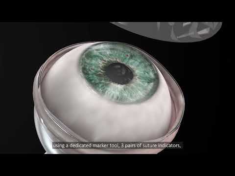 CorNeat KPro animation - video from CorNeat Vision
