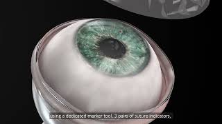 Corneat Kpro Animation