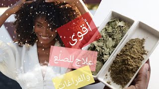 تسريع نمو الشعروعلاج تساقط الشعر نهائيا خلال اسبوع !hair treatment