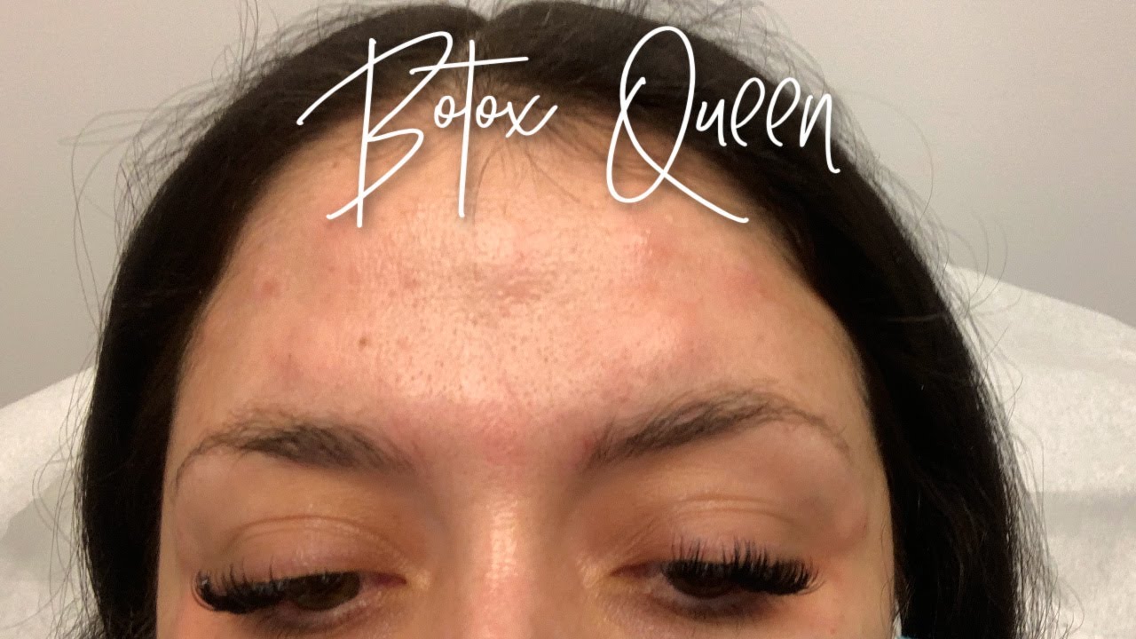 получаю 50 единиц ботокса 😍💉 я влюблена❤️