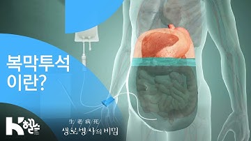 복막투석이란? - (20181024_667회 방송) 소리 없는 위협! 만성콩팥병