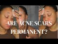 Are Acne Scars Permanent ? Acne Skincare Tips On Fading Scars EuniyceMari