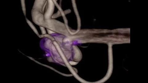 Middle cerebral artery aneurysm. WEB
