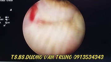 Cắt tuyến tiền liệt nội soi và tán sỏi- Ông Chinh- TS.BS.DUONG VĂN TRUNG 0913534343