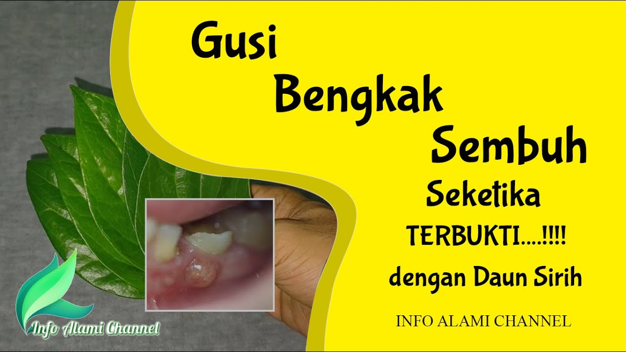 Obat GUSI BENGKAK Alami | Cara Mengobati Gusi Bengkak Karena Gigi