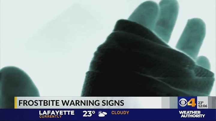Frostbite warning signs